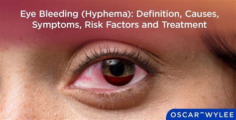 blood leaking from eye|Retinal Bleeding: Symptoms, Causes, Diagnosis, and。